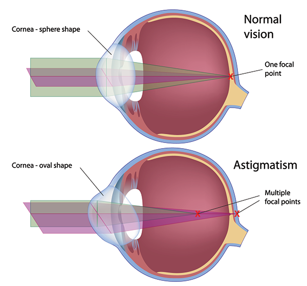 Astigmatism in Fort Worth