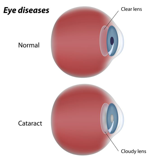 Eye Cataracts Exams and Treatments in Fort Worth, TX