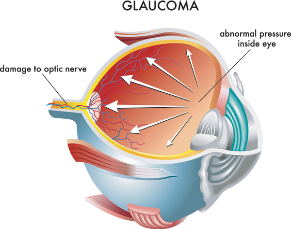 Glaucoma Treatments in Fort Worth, TX
