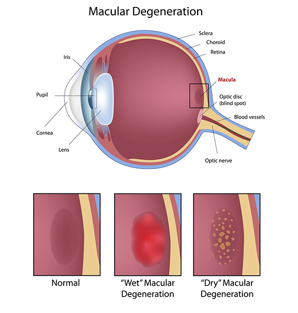  Macular Degeneration Fort Woth