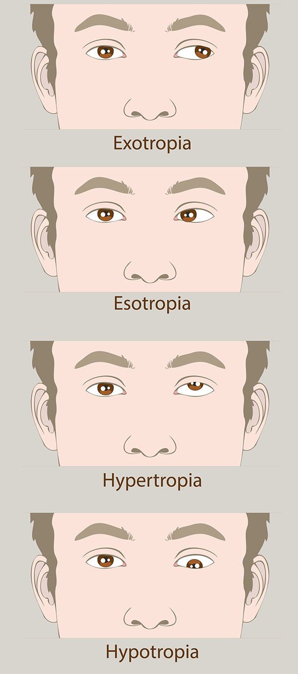 Amblyopia Treatments in Forth Worth, TX