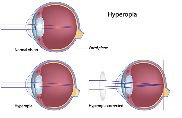 Farsightedness Treatments in Fort Worth, TX