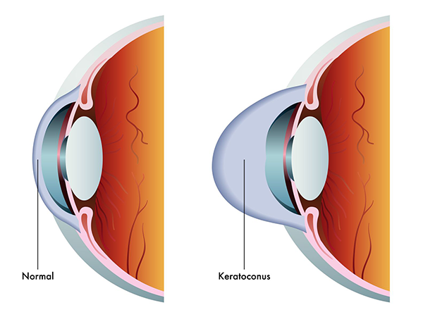 Keratoconus Treatments in Fort Worth, TX