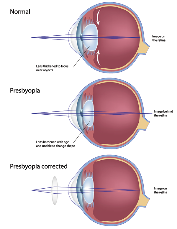 Presbyopia Fort Worth, TX