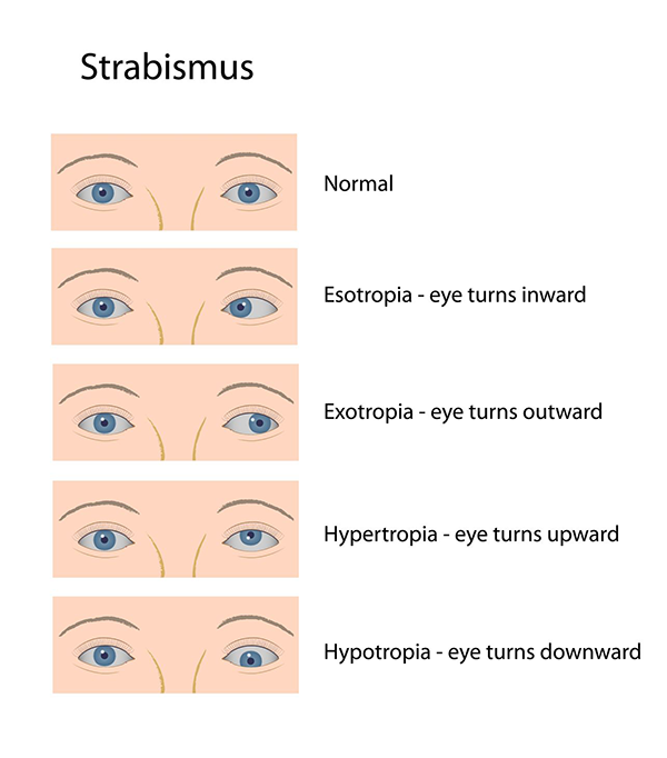 Strabismus Fort Worth